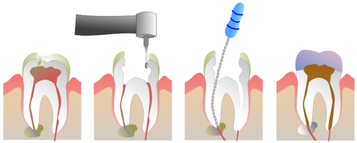 800px-Root_Canal_Illustration_Molar.svg
